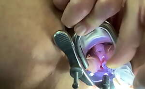 Numbing cervix with local anesthetic